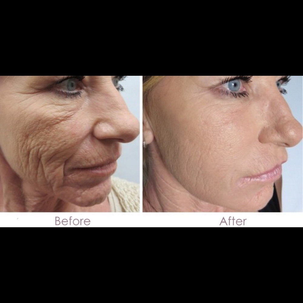 2 micro needling pens and tips